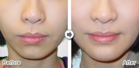 厚唇改薄恢复期有多长