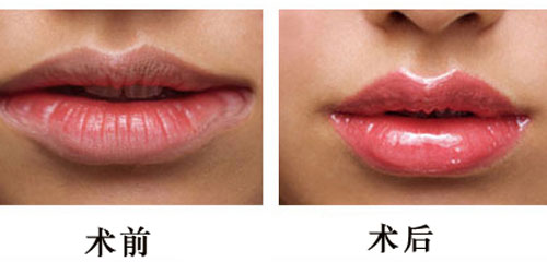 胶原蛋白丰唇的效果怎么样,注射丰唇材料,丰唇术