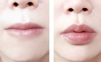 自体脂肪丰唇后需要多久恢复,丰唇术,自体脂肪丰唇术后的恢复时间,自体脂肪丰唇手术效果