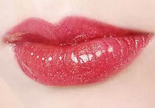 玻尿酸丰唇后该如何护理