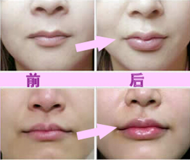 玻尿酸丰唇珠的效果，玻尿酸丰唇珠的效果，玻尿酸唇珠成形效果，唇珠成形术前注意事项，