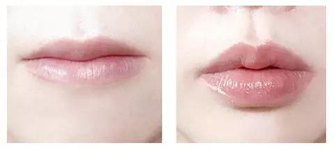 玻尿酸丰唇后会不会流失，玻尿酸丰唇效果，唇部塑形，注射的玻尿酸，丰唇的方法，玻尿酸丰唇后会不会流失，