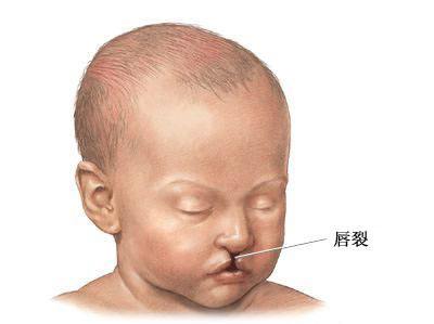 唇腭裂修复手术时间,唇颊沟畸形修复,腭裂修复术后