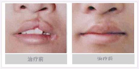 唇腭裂修复手术怎么做,唇裂修复手术最佳时期