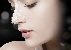 玻尿酸打下巴,玻尿酸打下巴需要多少毫升,玻尿酸注射丰下后