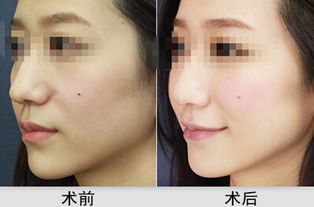 丰苹果肌的方法