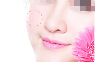 玻尿酸丰苹果肌的注意事项