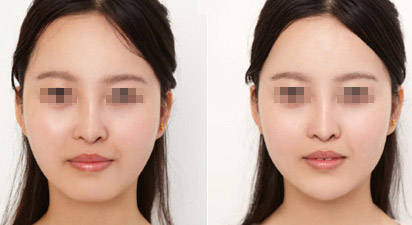 假体丰下巴前的注意事项