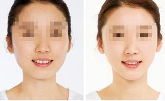 武汉注射丰下巴多少钱