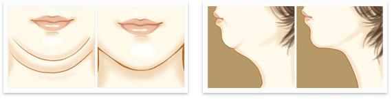 脸部吸脂的危害,脸部抽脂术后的护理,脸部吸脂术后应该如何护理呢,脸部吸脂减肥的危害是什么