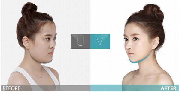 韩式面部吸脂整形,韩式面部吸脂整形需要多少钱，韩式面部吸脂瘦脸效果