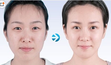 面部吸脂后会反弹吗,面部吸脂后是否反弹 ,面部吸脂瘦脸效果