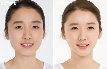 假体垫下巴后的恢复期