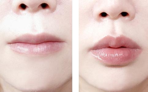 成都注射玻尿酸丰唇,成都玻尿酸丰唇的价格,成都注射玻尿酸丰唇多少钱