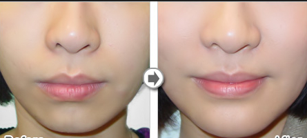 丰下巴手术后的护理