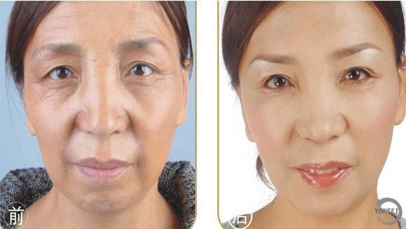 面部激光除皱能保持多久,一般面部激光除皱能维持多久，面部激光除皱可以保持多久，做激光除皱的效果