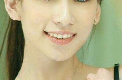 假体丰下巴的效果