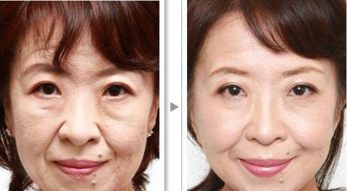 自体脂肪填充下巴永久吗,自体脂肪填充下巴存活率由什么决定，自体脂肪填充会被吸收