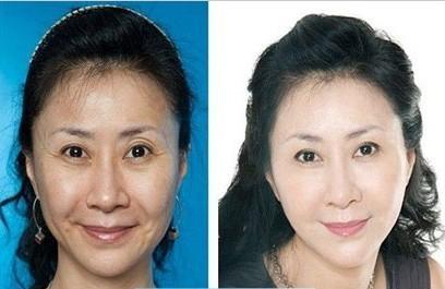 面部除皱整容,面部除皱整容一般会采用什么方法,面部除皱整容有什么风险