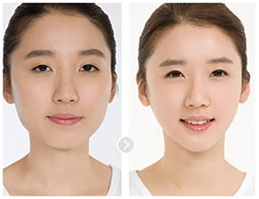 面部吸脂手术有什么特点