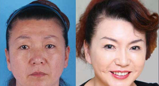 激光除皱需要多少钱,激光除皱大概多少钱,深度皱纹去除的价格,浅层的皱纹价格