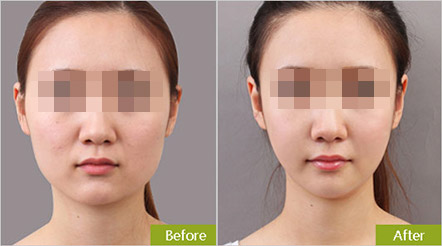 面部吸脂手术是怎样进行