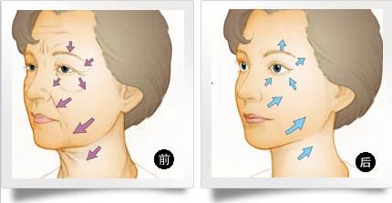 除皱电波拉皮的优势