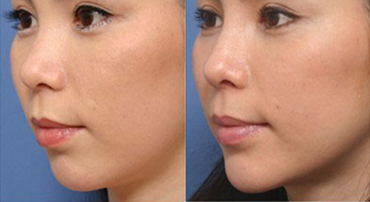 自体脂肪丰下巴  