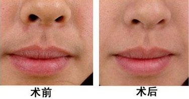 激光脱毛怎么样