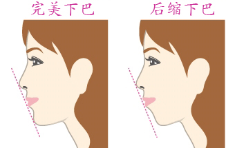 隆下巴有几种方法