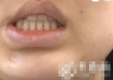 整容后下巴变歪