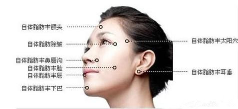 自体脂肪面部填充