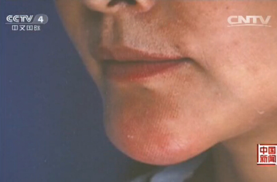 生子因子副作用一