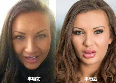 佩奇注射丰唇前后对比图
