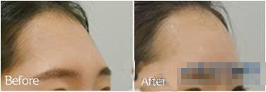 注射玻尿酸丰额头