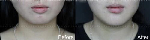 圆脸变鹅蛋脸？C10隆下巴就够了