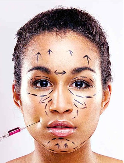 注射微整形示意图