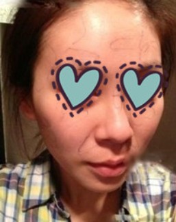 　“bqqqzf215321”做自体脂肪填充面部前