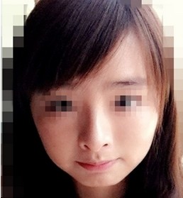 注射玻尿酸丰下巴前