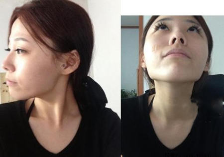 女子磨骨整形摆脱高颧骨