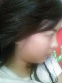 面部吸脂前样子