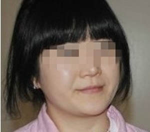 女网友体验面部吸脂术