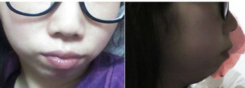 女子自觉短下巴难看