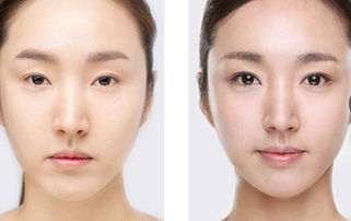 注射瘦脸针后的恢复期