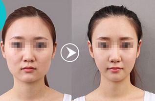 注射瘦脸针后的副作用