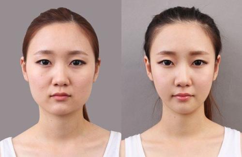 脸部吸脂需要多少钱,面部吸脂瘦脸大约要多少钱,影响面部吸脂手术价格的因素