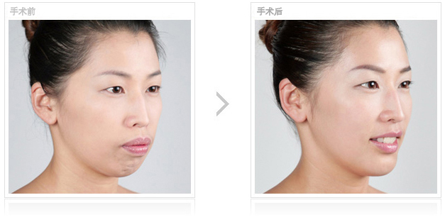 改脸型手术 