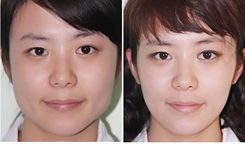 脸部矫正整形手术