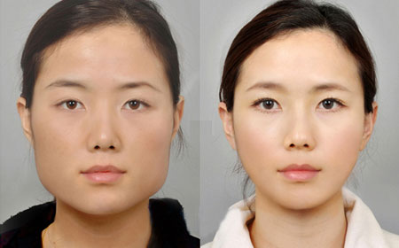 改脸型手术真的能瘦脸吗