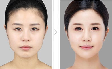 脸部整形多少钱